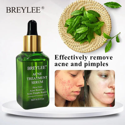 acne treatment serum